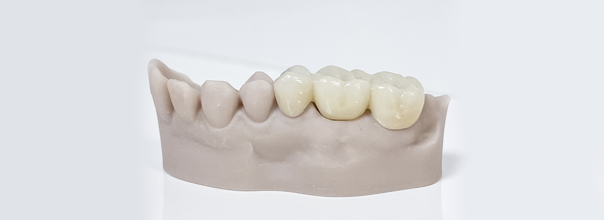 Dental Bridges