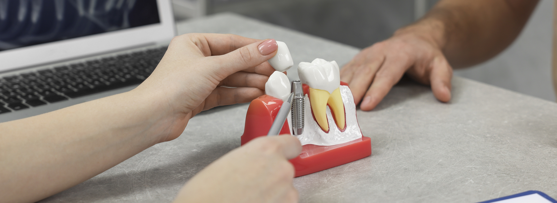 Dental Implants