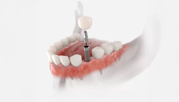 Dental Implants and Facial Aesthetics: Enhancing Your Natural Look