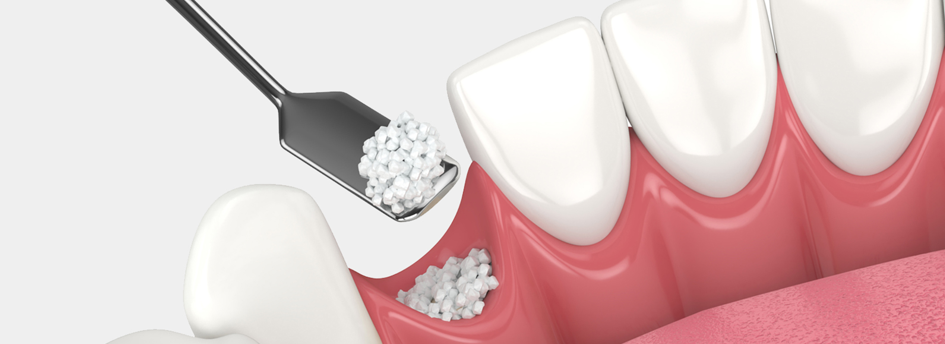 Bone-Graft