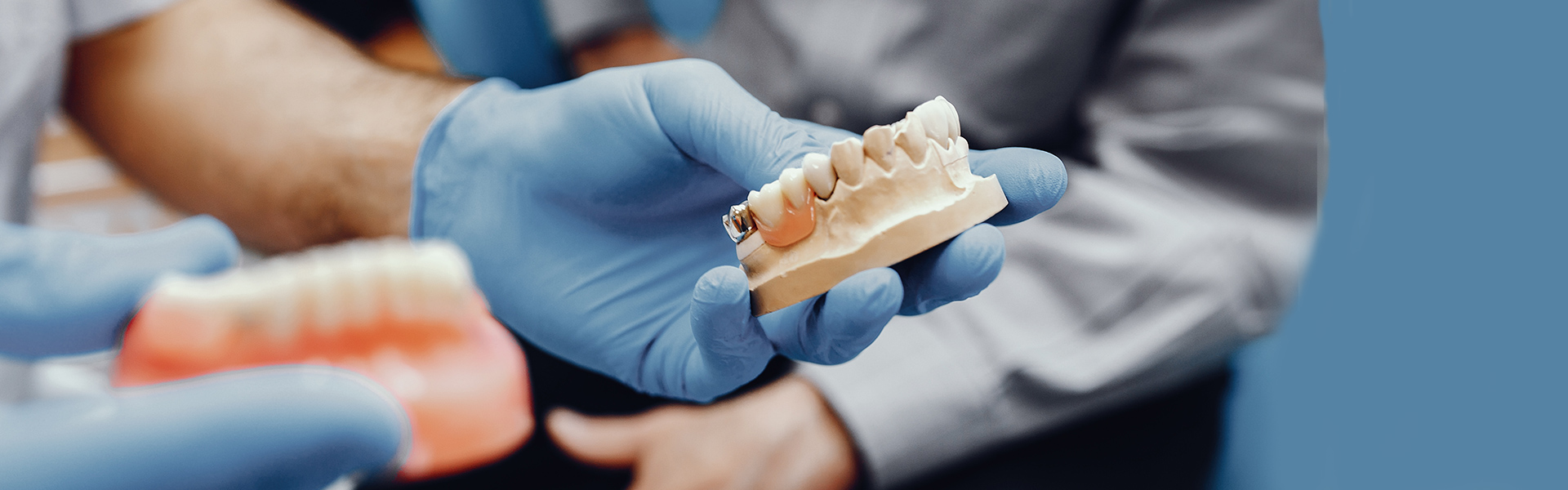 Looking for Affordable Dental Bridges in Miami? Here’s What You Need to Know!