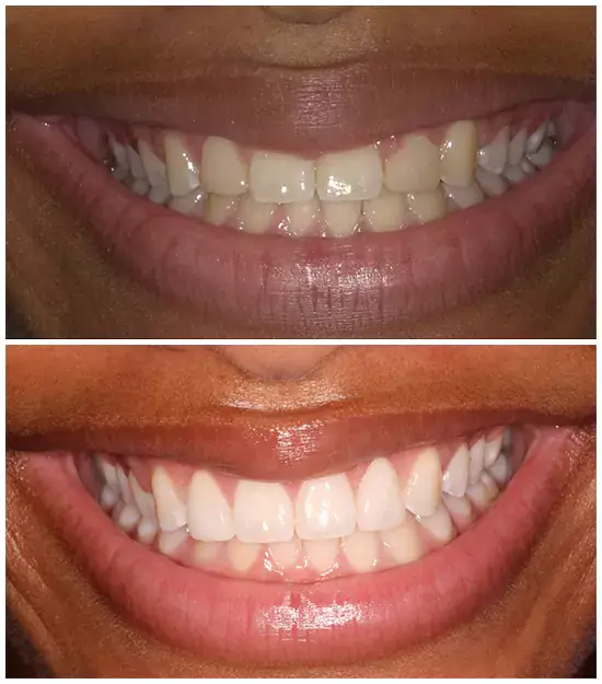 Treatment Before & After Effects- ONE Dental