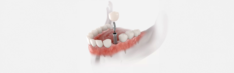 Dental-Implants