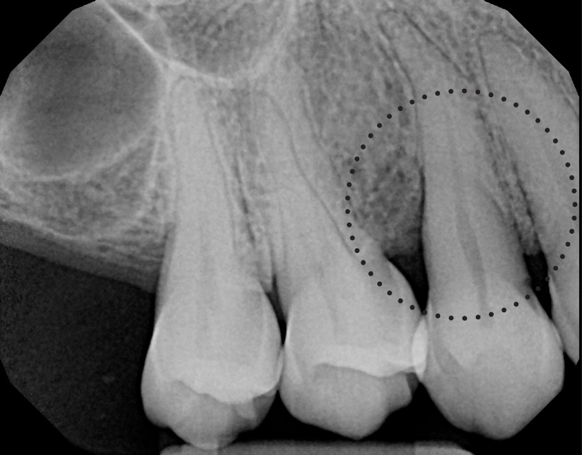 Before and After of LANAP Laser Treatment