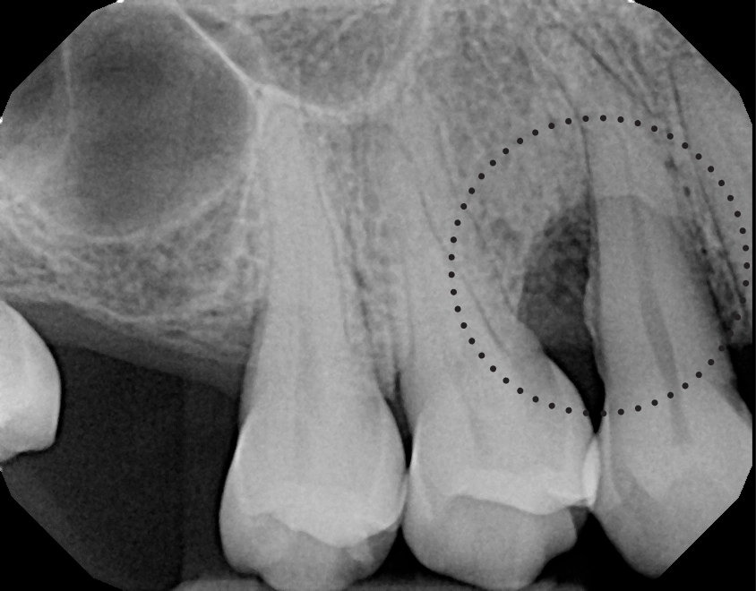 Before and After of LANAP Laser Treatment