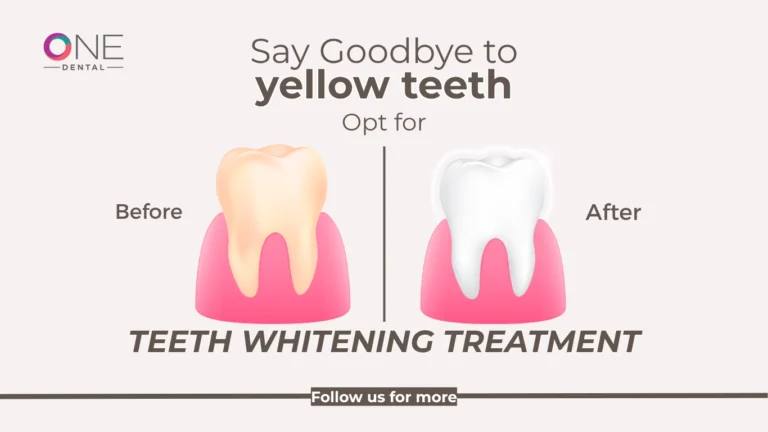 Say Goodbye to Yellow Teeth