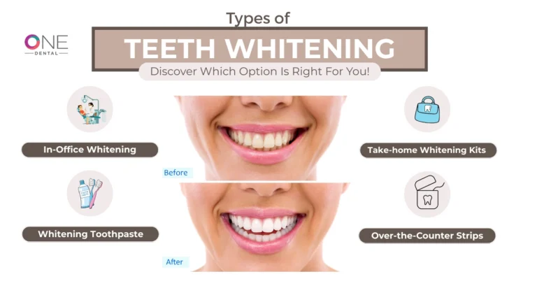 Teeth Whitening Before and After